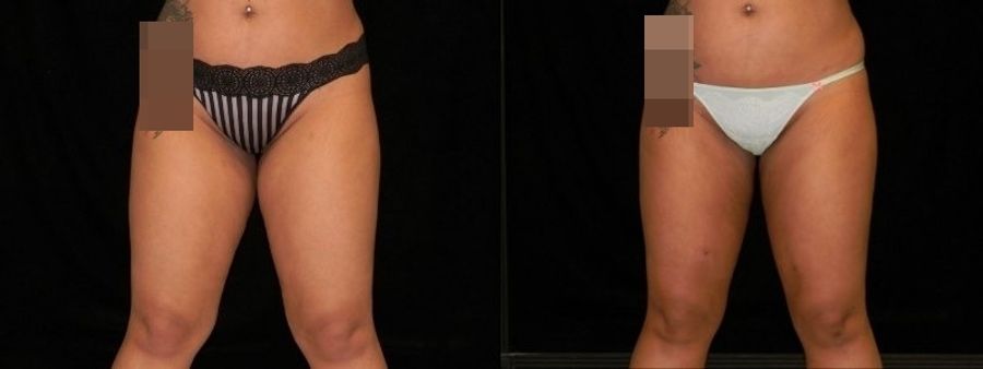 Before and after Liposuction case 32737