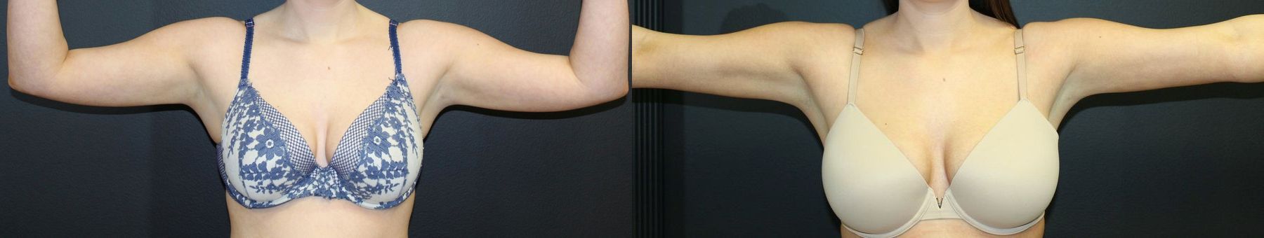 Before and after Liposuction case 32767 - Angle 2