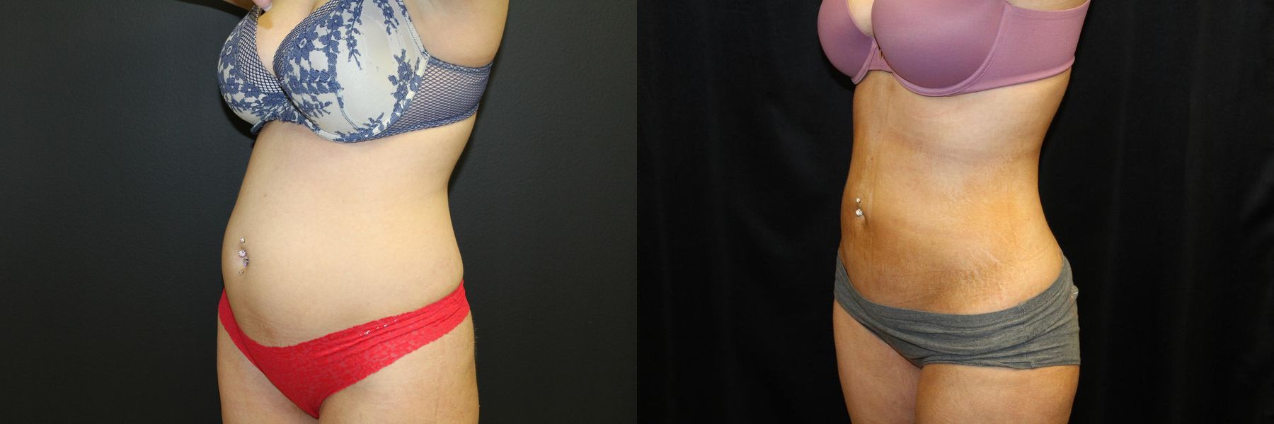 Before and after Liposuction case 32769 - Angle 3