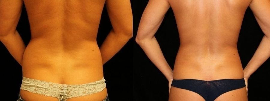 Before and after Liposuction case 32736