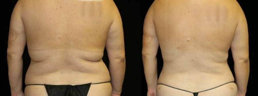 Before and after Liposuction case 32739
