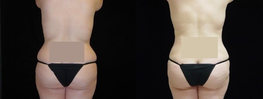Before and after Liposuction case 32755