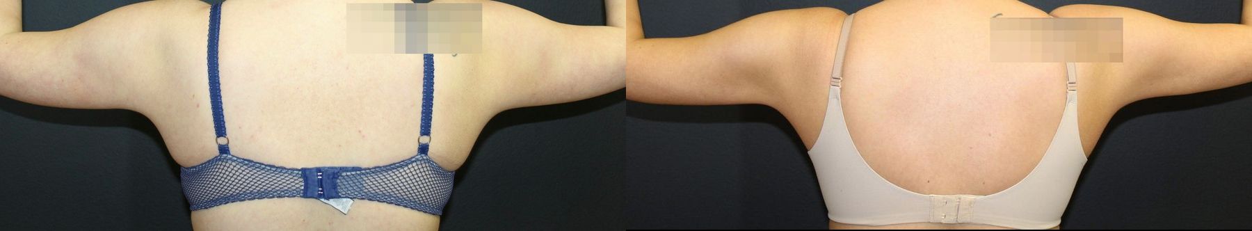 Before and after Liposuction case 32767