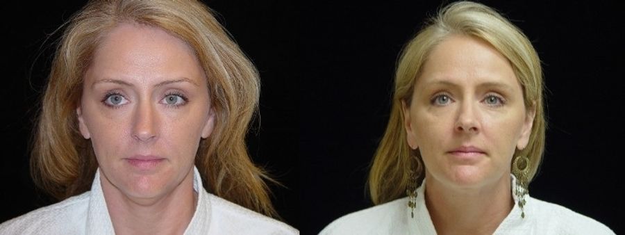 Before and after Liposuction of the Neck case 32745
