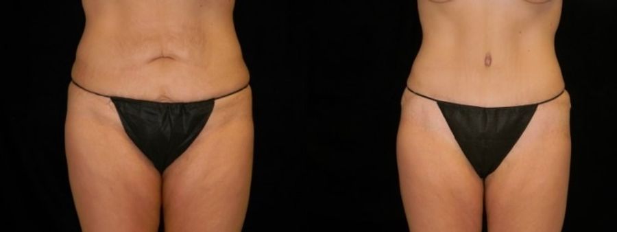 Before and after Mommy Makeover case 32642