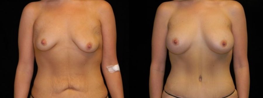 Before and after Mommy Makeover case 32585