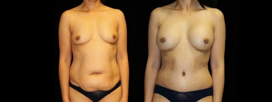 Before and after Mommy Makeover case 32622