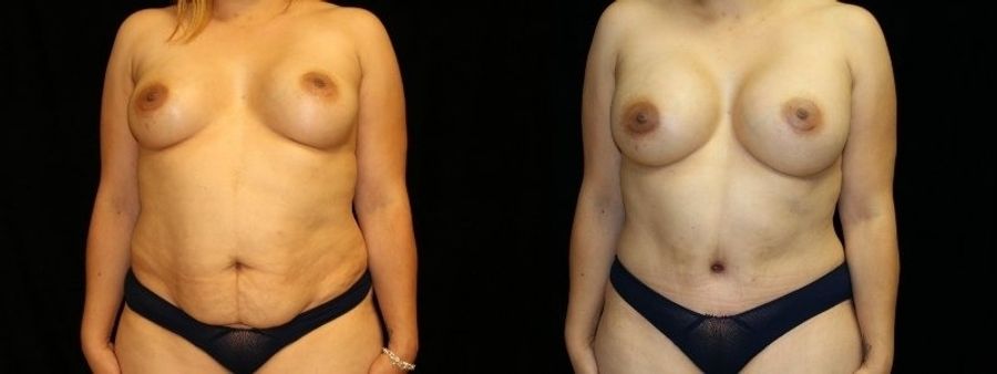 Before and after Mommy Makeover case 32641