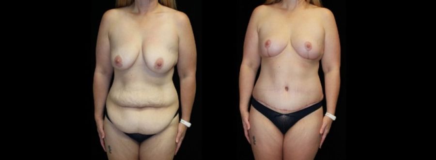 Before and after Mommy Makeover case 32603