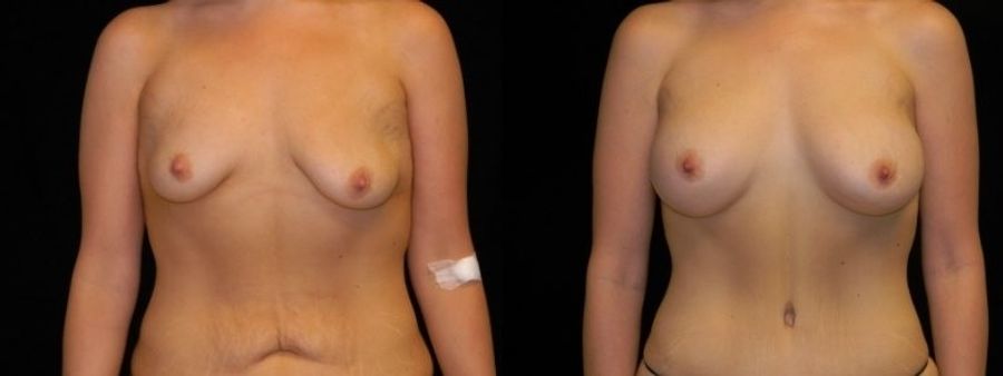 Before and after Mommy Makeover case 32658