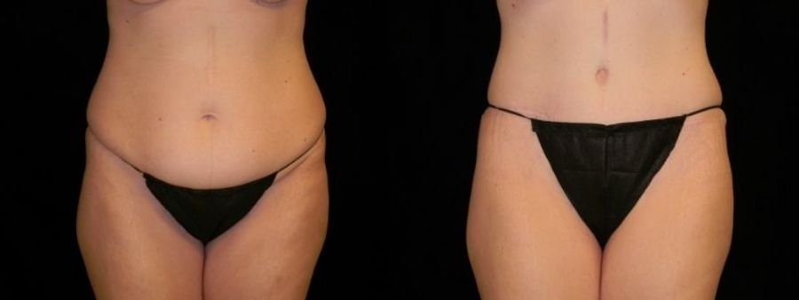 Before and after Mommy Makeover case 32662
