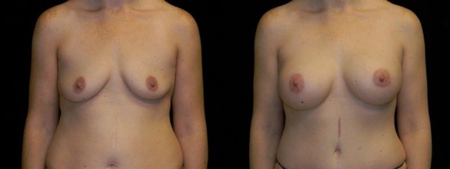 Before and after Mommy Makeover case 32651
