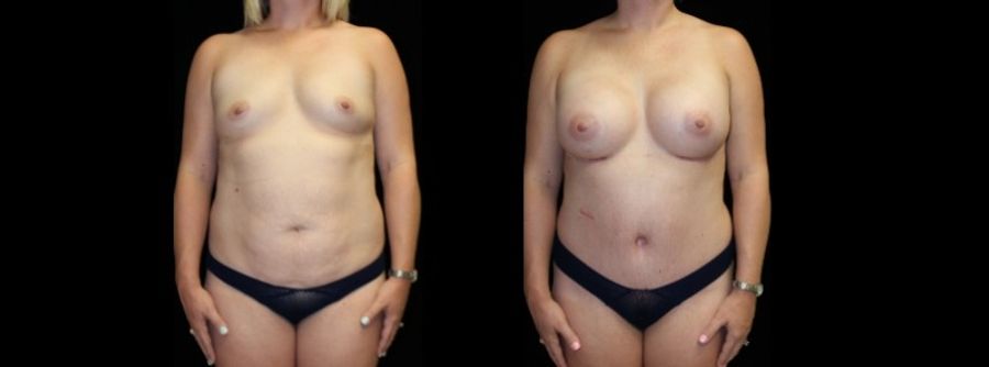 Before and after Mommy Makeover case 32579
