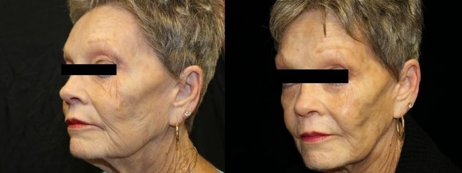 Before and after Sculptra® case 32746 - Angle 2