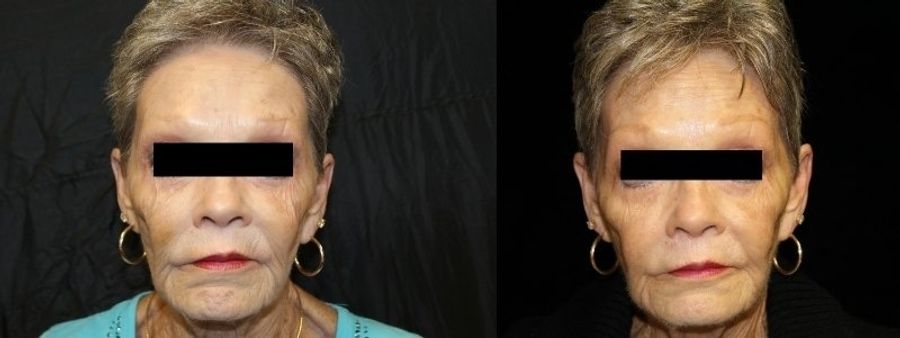 Before and after Sculptra® case 32746