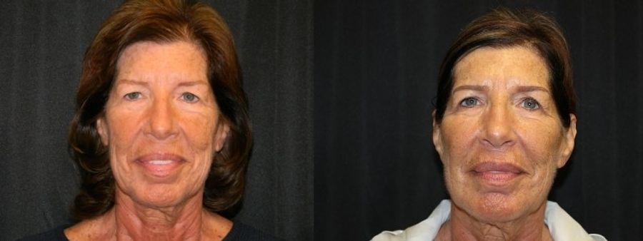 Before and after Sculptra® case 32748