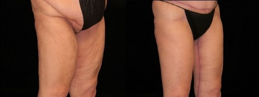 Before and after Thigh Lift case 32744
