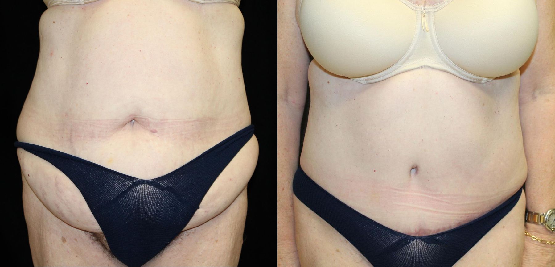 Before and after Tummy Tuck case 32654