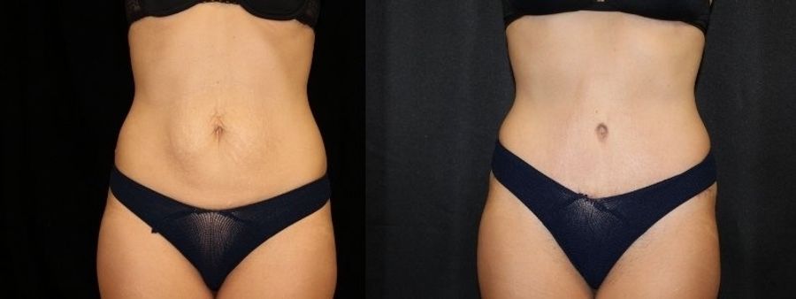 Before and after Tummy Tuck case 32668