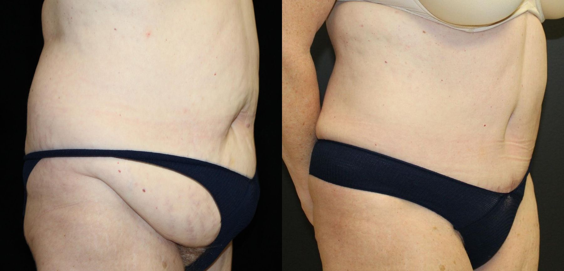 Before and after Tummy Tuck case 32654 - Angle 2
