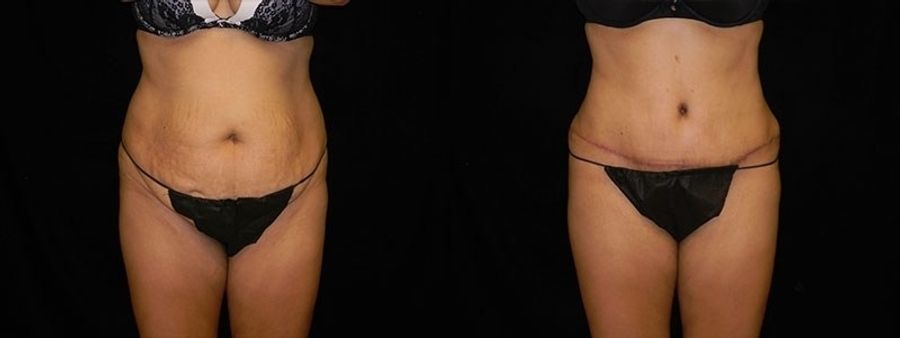 Before and after Tummy Tuck case 32644