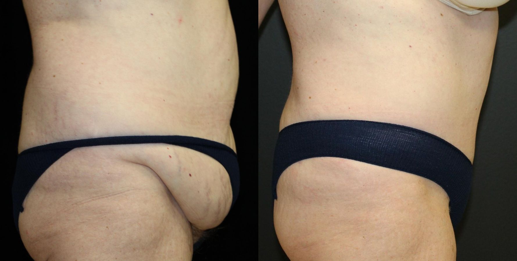 Before and after Tummy Tuck case 32654 - Angle 3