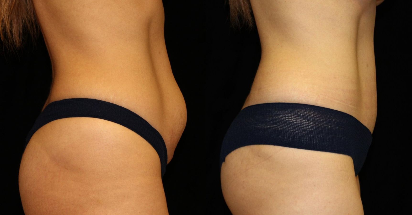 Before and after Tummy Tuck case 32715 - Angle 3