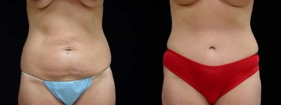 Before and after Tummy Tuck case 32645