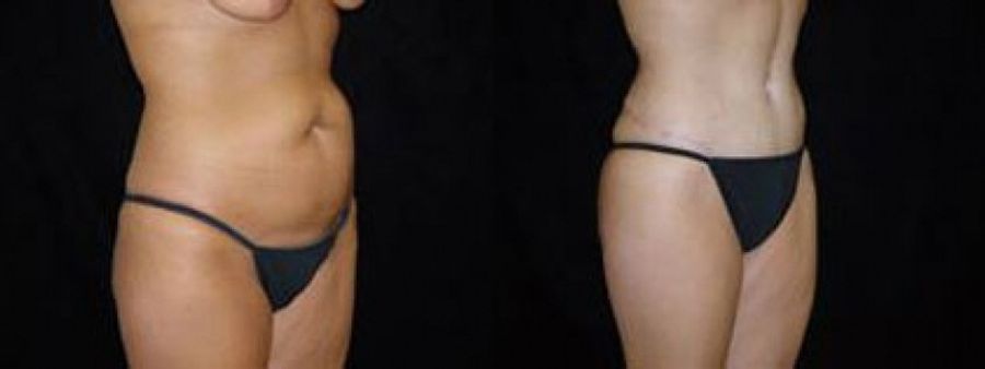 Before and after Tummy Tuck case 32680