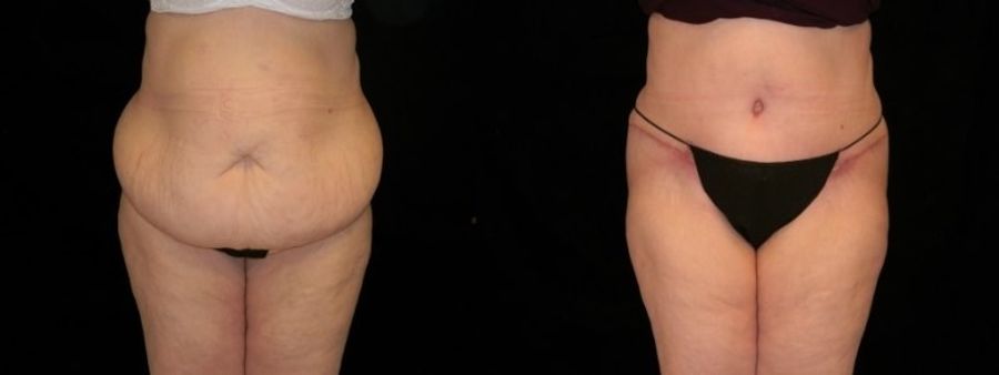 Before and after Tummy Tuck case 32689
