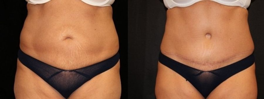 Before and after Tummy Tuck case 32672
