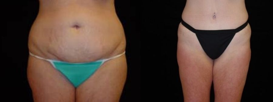 Before and after Tummy Tuck case 32616