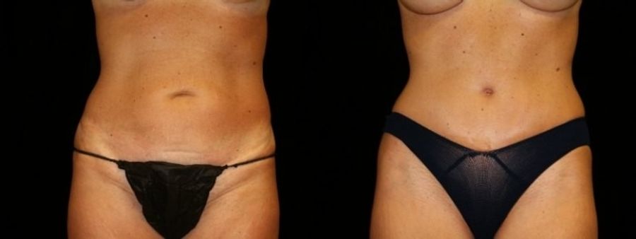 Before and after Tummy Tuck case 32578