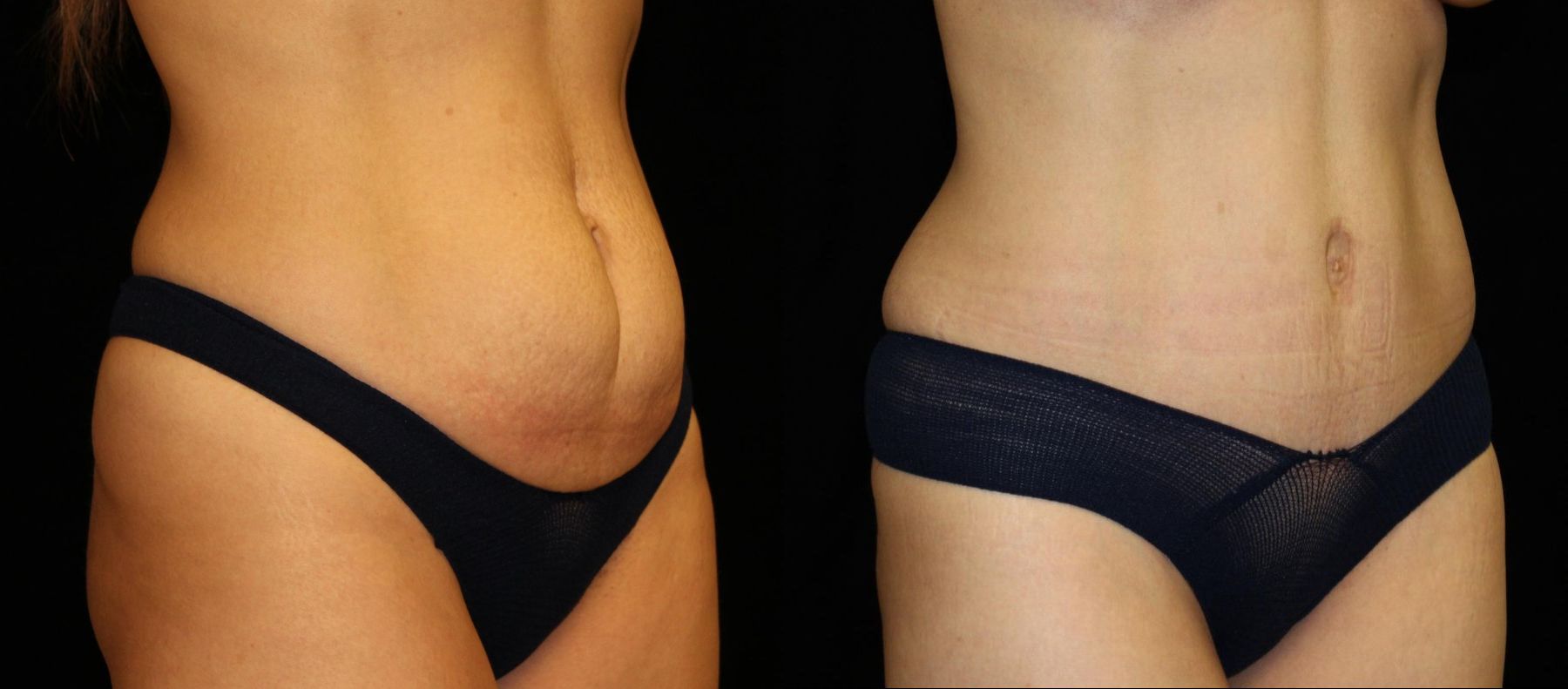 Before and after Tummy Tuck case 32715 - Angle 2