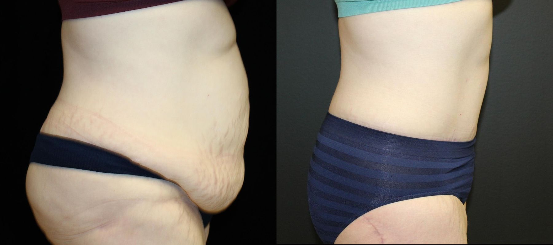 Before and after Tummy Tuck case 32653 - Angle 3