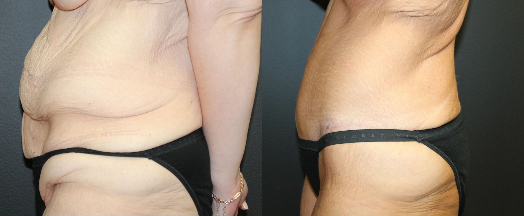 Before and after Tummy Tuck case 32735 - Angle 3