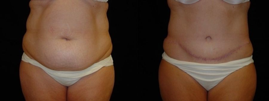 Before and after Tummy Tuck case 32712