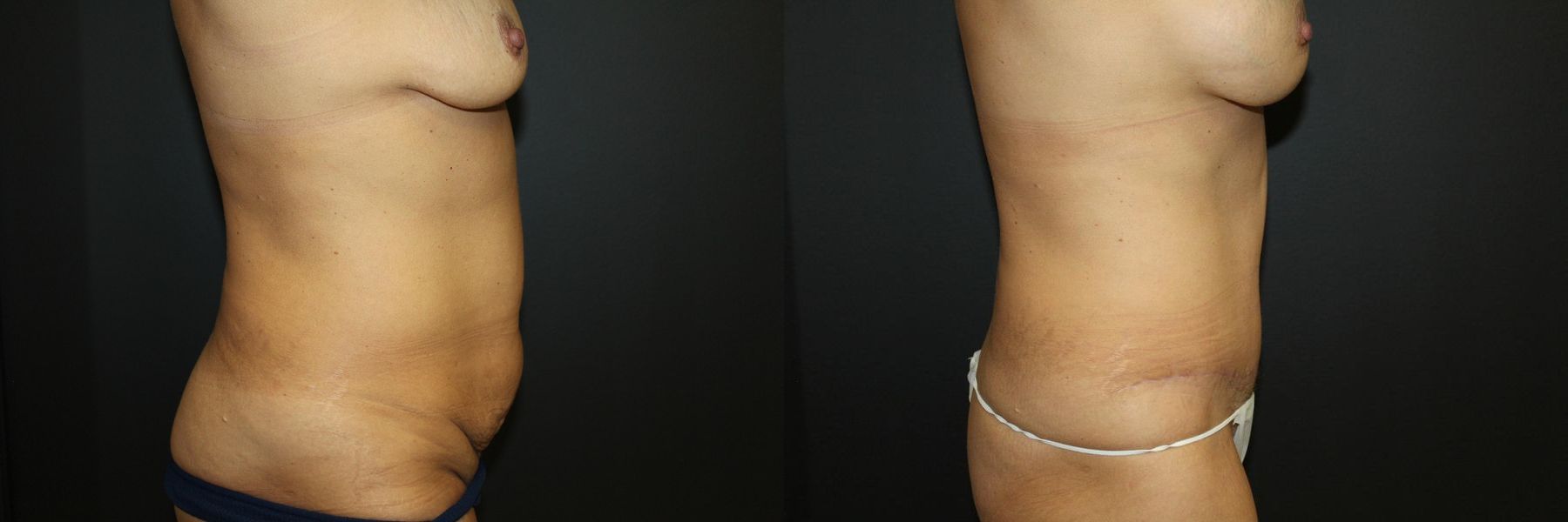 Before and after Tummy Tuck case 32590 - Angle 3