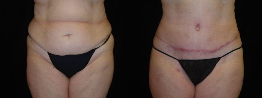 Before and after Tummy Tuck case 32702