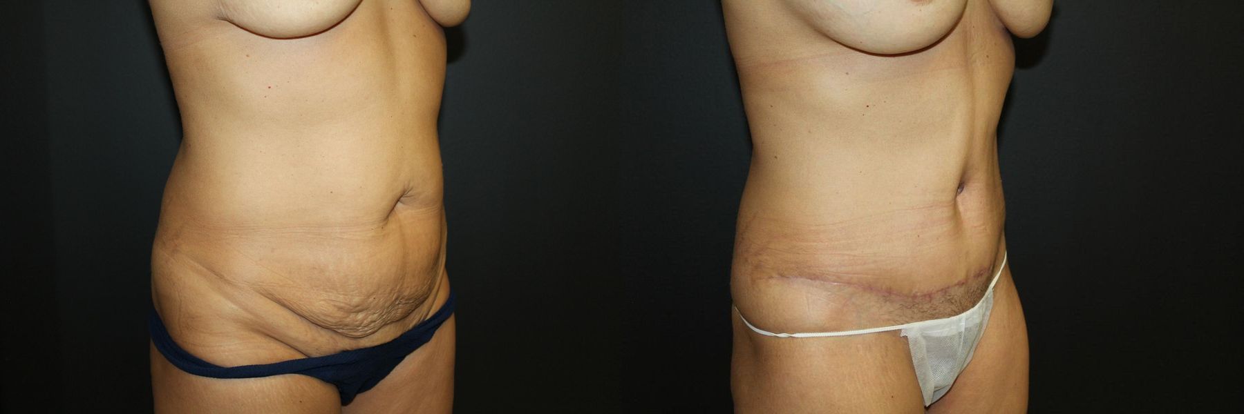 Before and after Tummy Tuck case 32590 - Angle 2