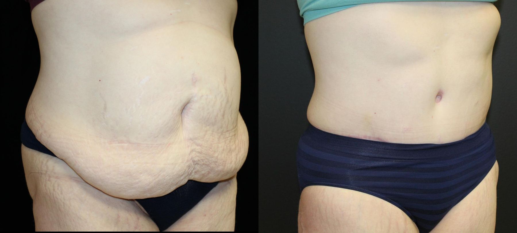Before and after Tummy Tuck case 32653 - Angle 2