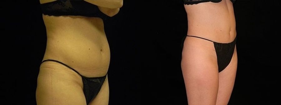 Before and after Tummy Tuck case 32681
