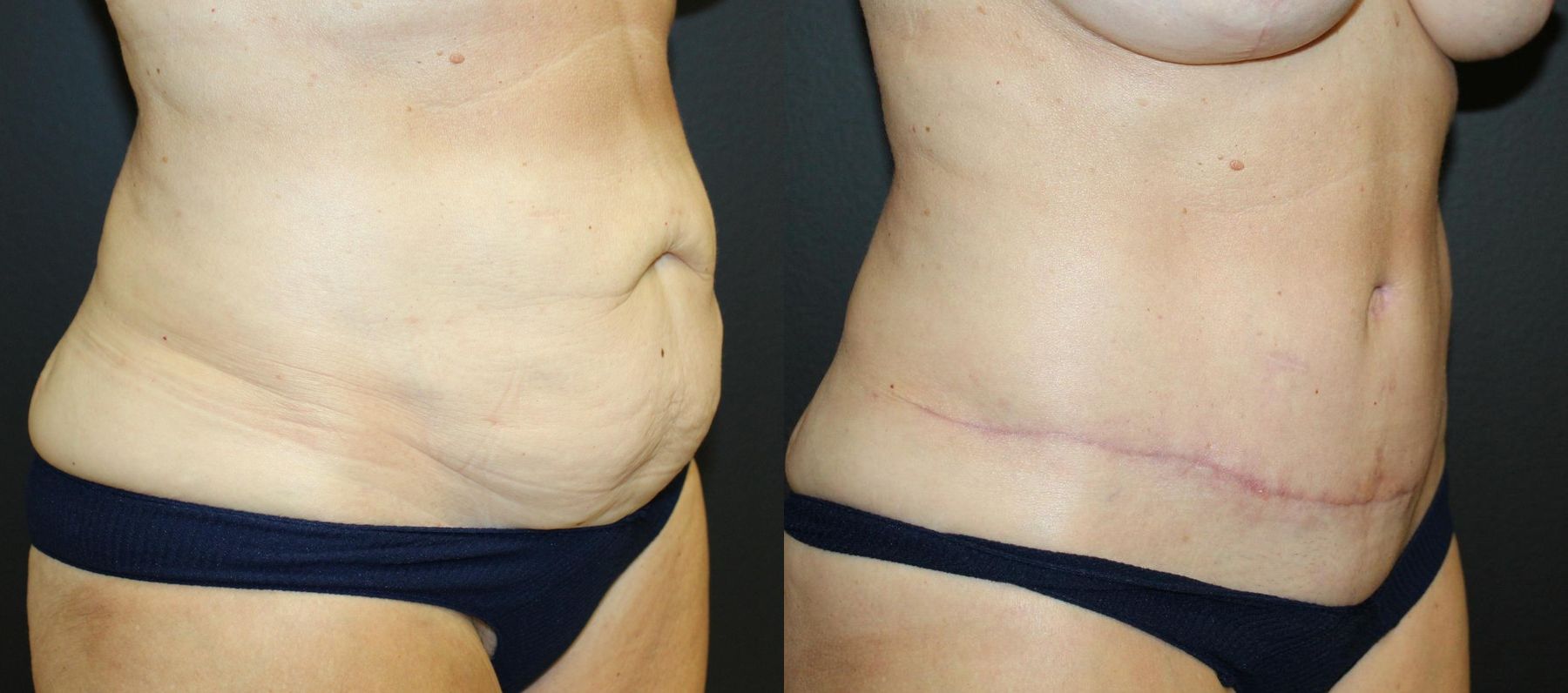 Before and after Tummy Tuck case 32675 - Angle 2