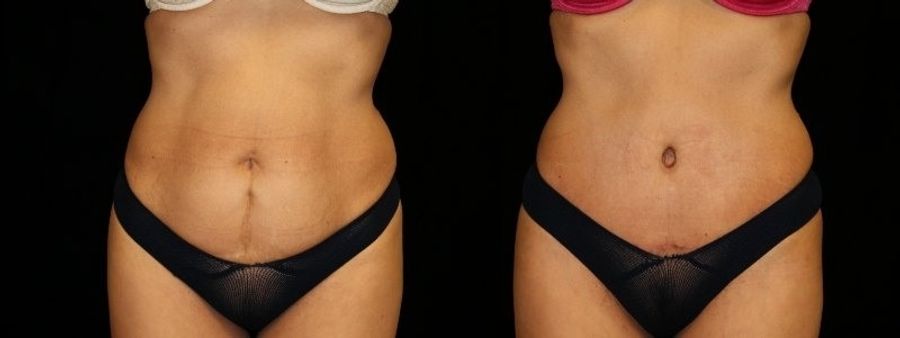 Before and after Tummy Tuck case 32605