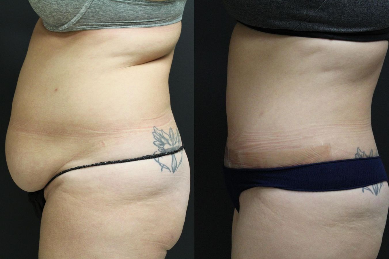 Before and after Tummy Tuck case 32655 - Angle 3