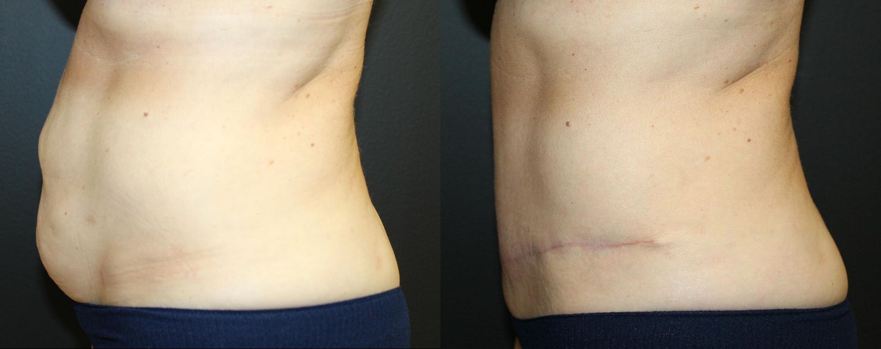 Before and after Tummy Tuck case 32675 - Angle 4