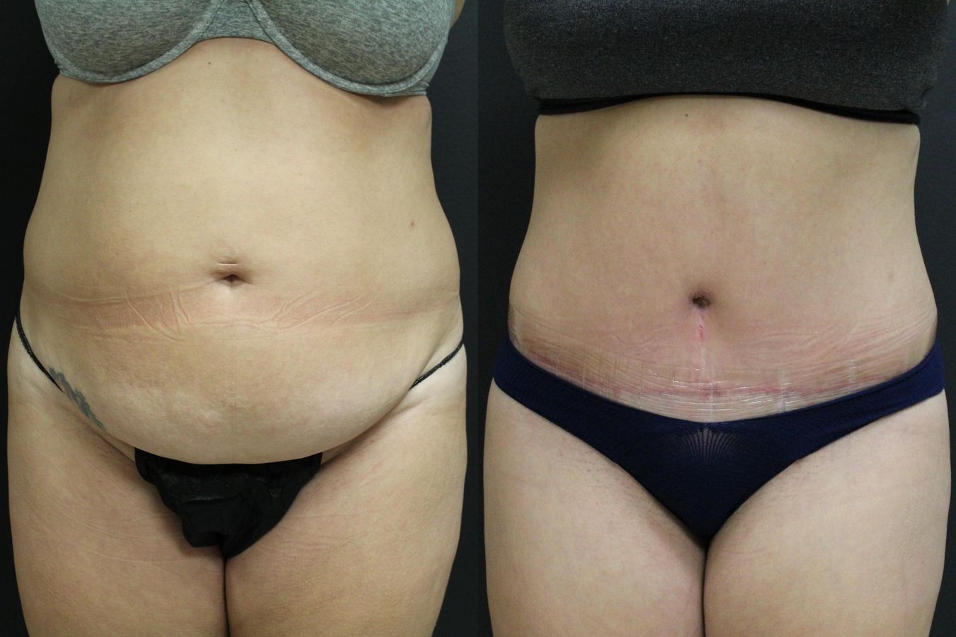 Before and after Tummy Tuck case 32655