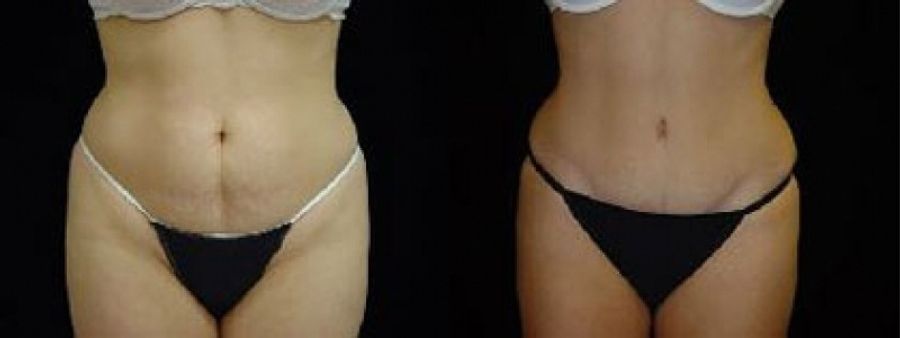 Before and after Tummy Tuck case 32710