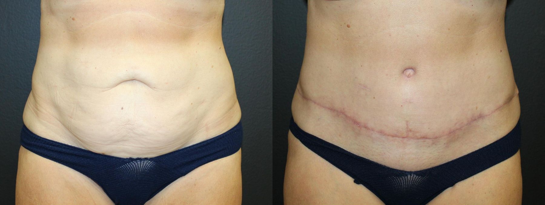 Before and after Tummy Tuck case 32675
