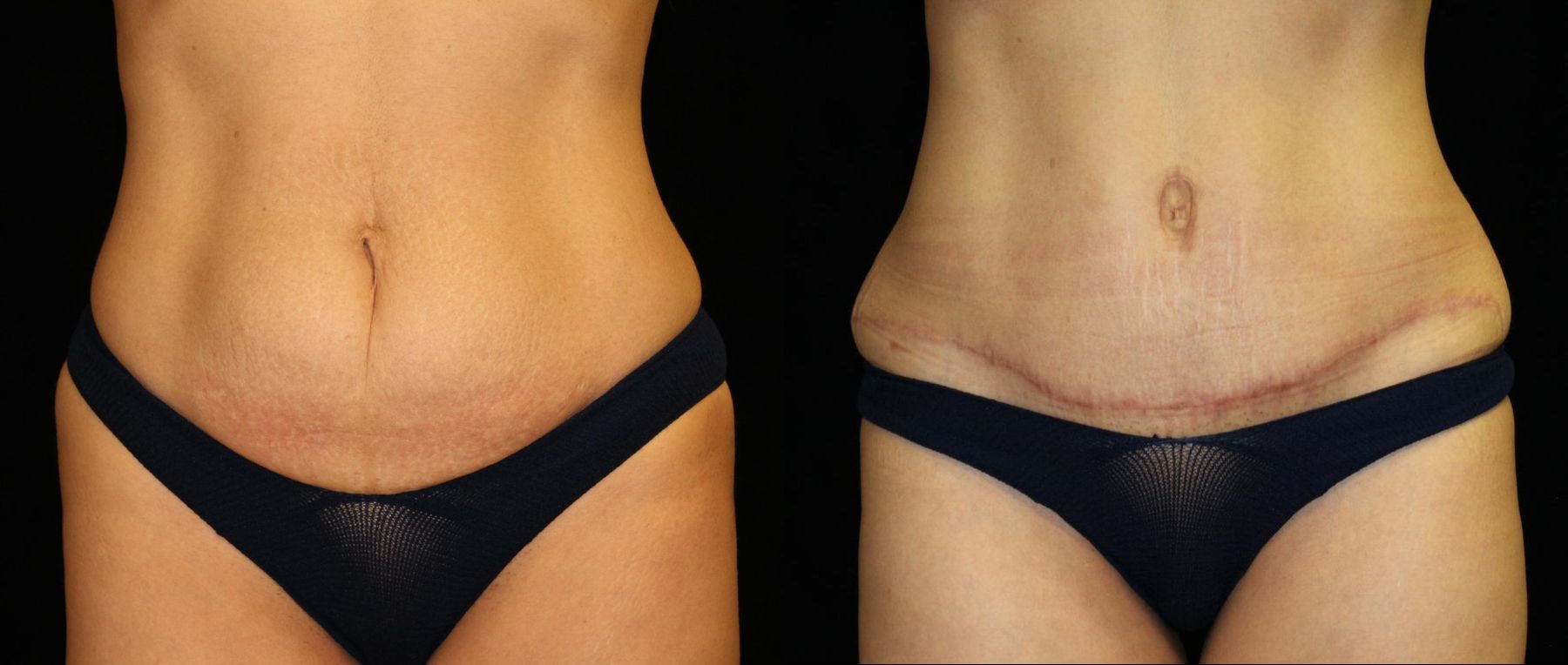 Before and after Tummy Tuck case 32715